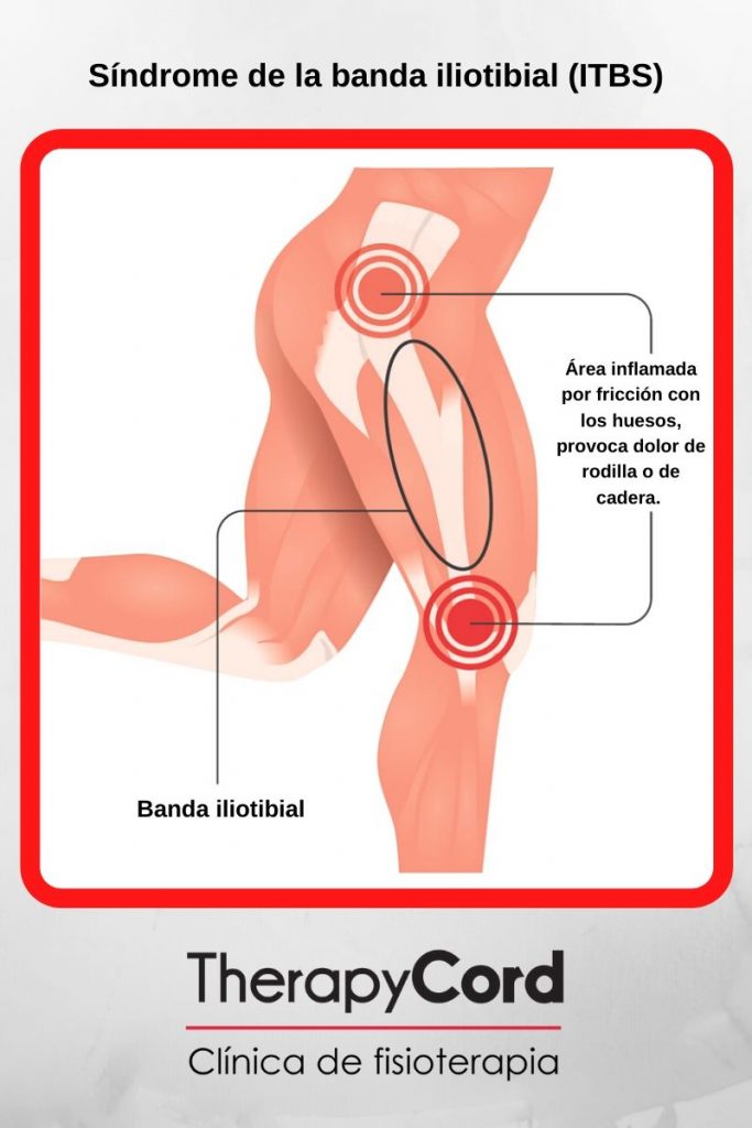 Síndrome de la banda iliotibial